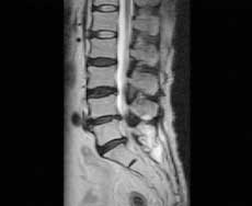 lumbar herniated disc