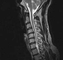 Degenerative Disc Disease