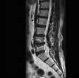 Degenerative Disc Disease