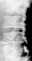 Scoliosis